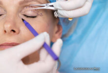 Adonis Surgery on the Benefits of Blepharoplasty