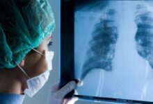 Pacientes latinoamericanos con hipertensión pulmonar desafían las expectativas mundiales